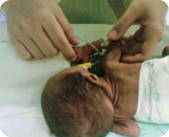 After two months old, she breathed on her own. Respirators and pure oxygen were no longer needed.