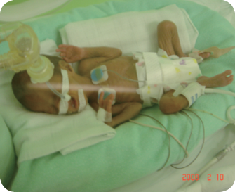 On the eleventh day after she was born, she still relied on respirators and pure oxygen.